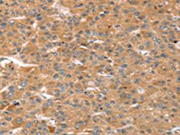 The image on the left is immunohistochemistry of paraffin-embedded Human liver cancer tissue using CSB-PA346002(CAPN7 Antibody) at dilution 1/20, on the right is treated with fusion protein. (Original magnification: ×200)