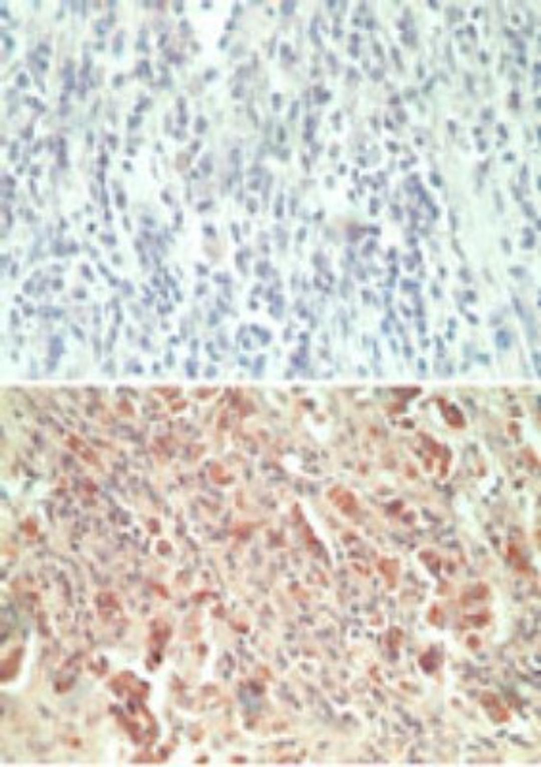 Immunohistochemistry-Paraffin: GPR18 Antibody [NBP2-24918] - Analysis of paraffin-embedded formalin-fixed human breast tumor tissue using an isotype control (top) and GPR18 antibody (bottom) at 5 ug/ml.