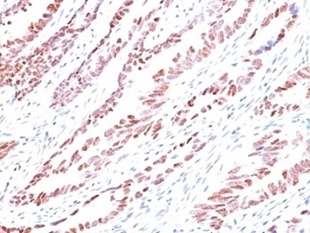 Formalin-fixed, paraffin-embedded human colon carcinoma stained with p57 antibody (KP10).