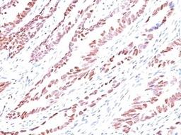 Formalin-fixed, paraffin-embedded human colon carcinoma stained with p57 antibody (KP10).