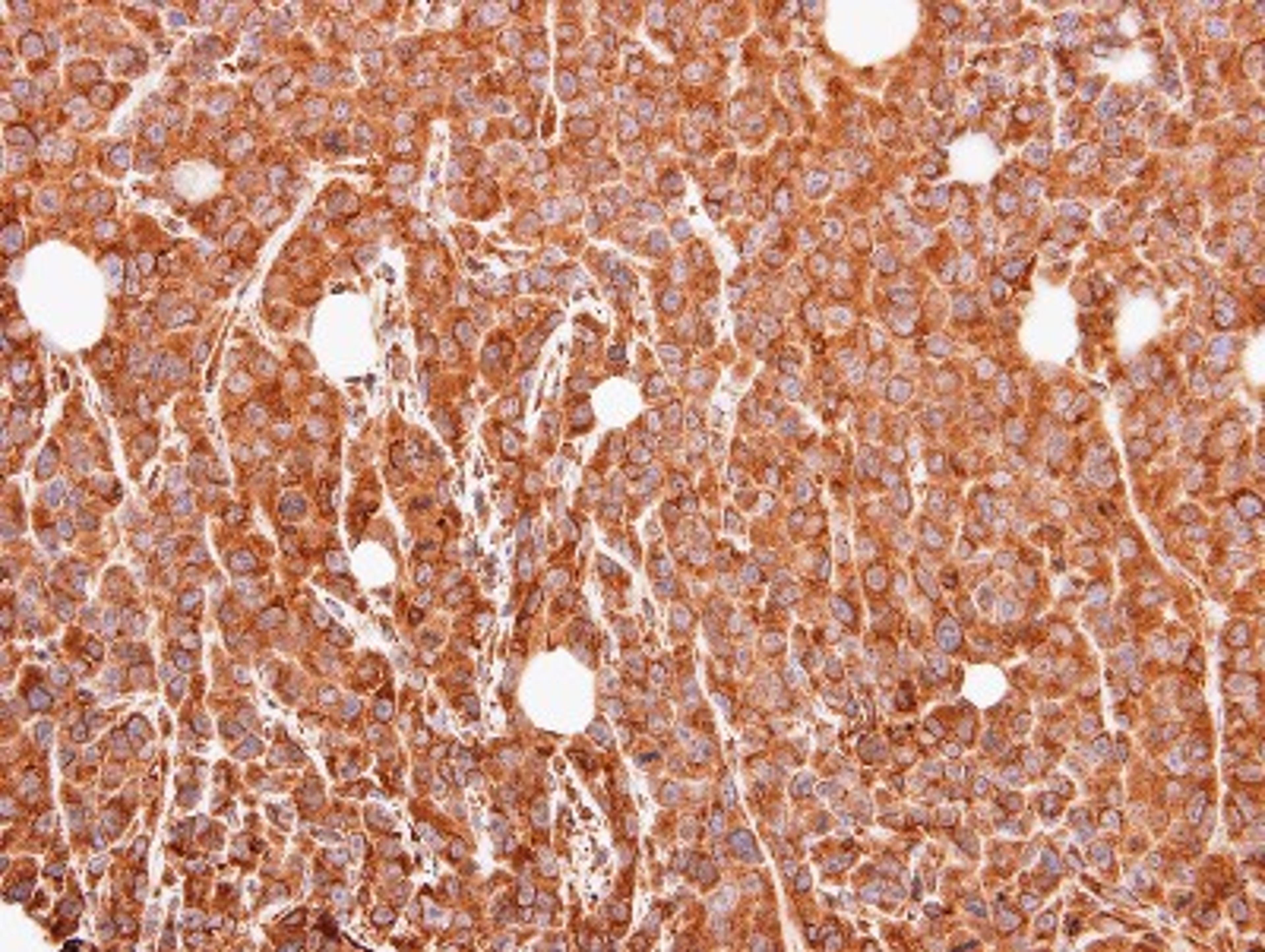 Immunohistochemistry-Paraffin: MUC2 Antibody [NBP1-31231] - Paraffin-embedded SAS xenograft, using antibody at 1:500 dilution.