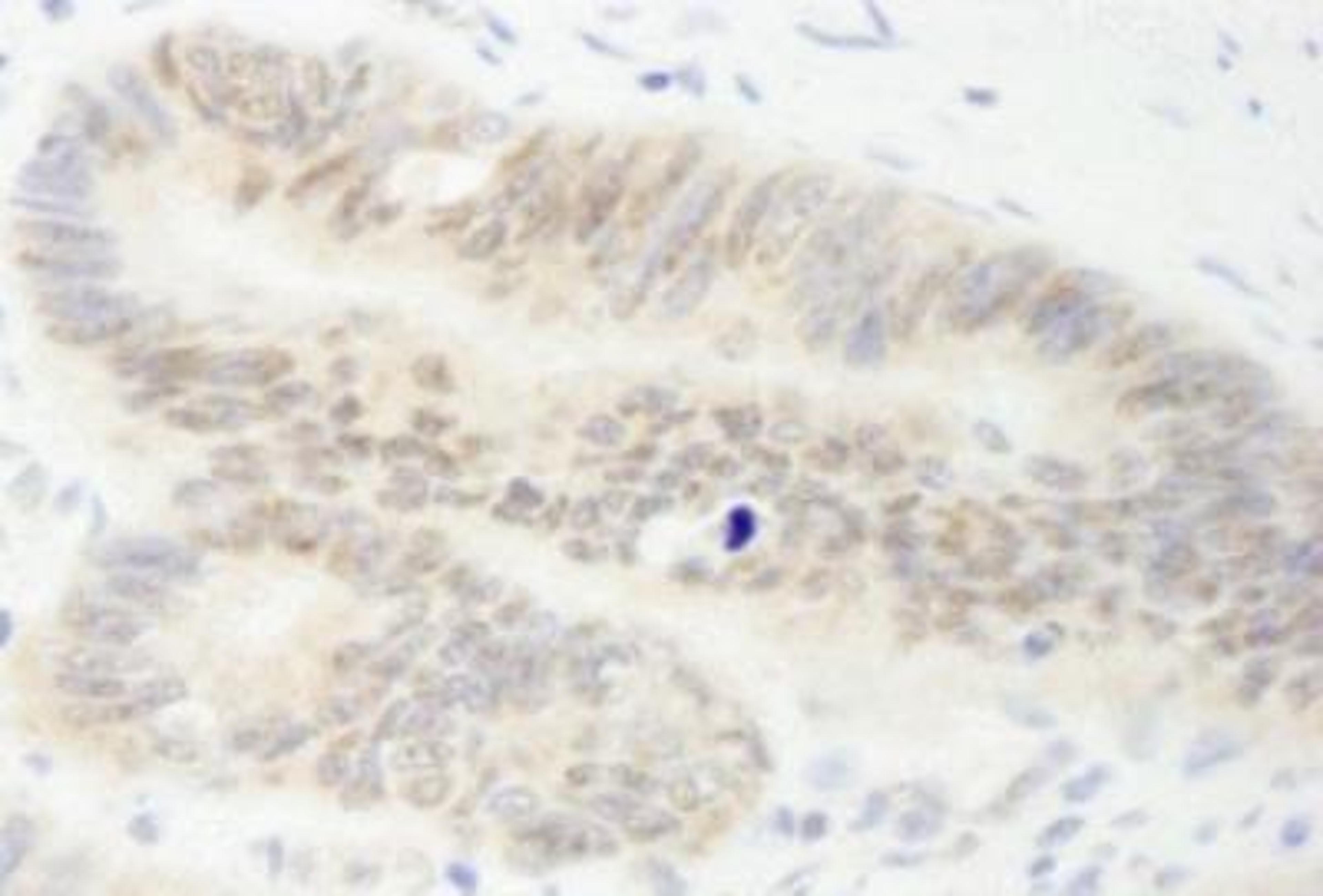 Immunohistochemistry-Paraffin: MYBBP1A Antibody [NB100-61050] - Human colon carcinoma.