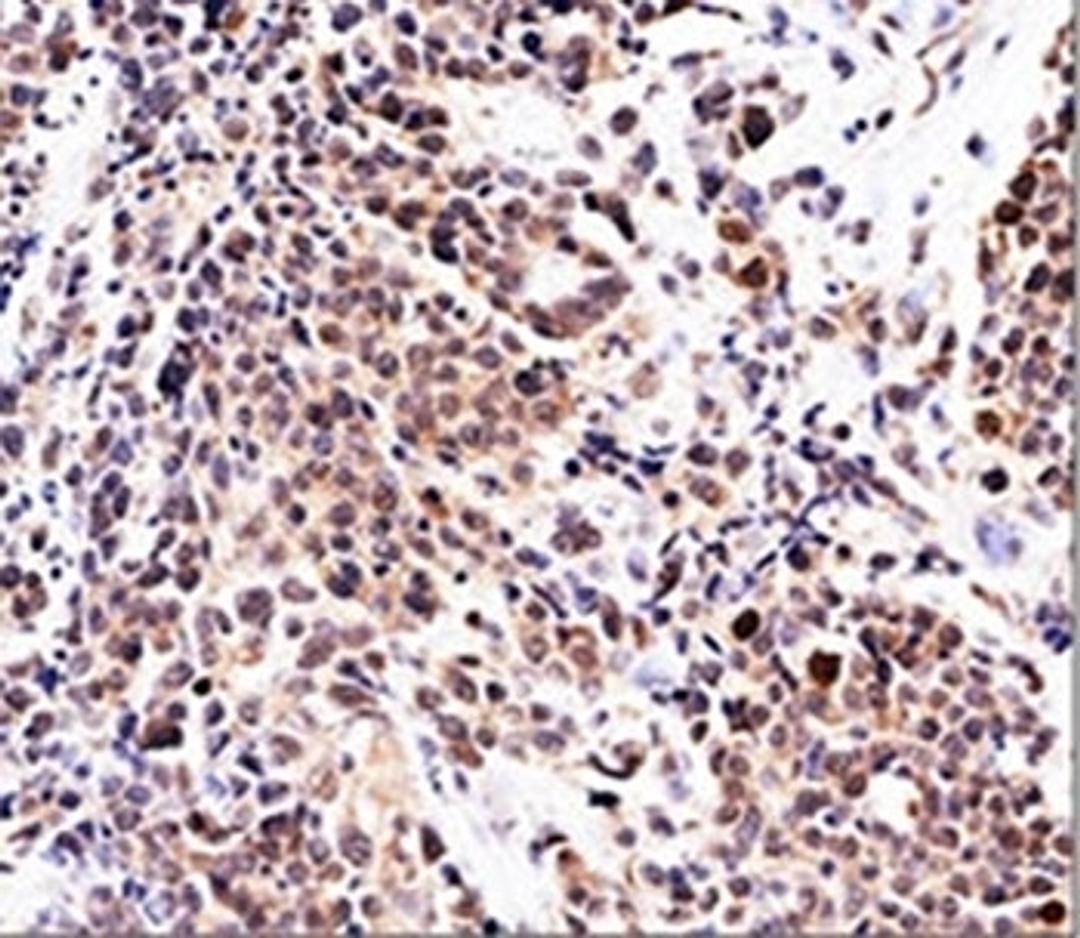 IHC testing of urinary transitional cell carcinoma stained with p21 antibody (WA-1).