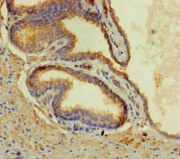 Immunohistochemistry of paraffin-embedded human prostate cancer using CSB-PA880087LA01HU at dilution of 1:100