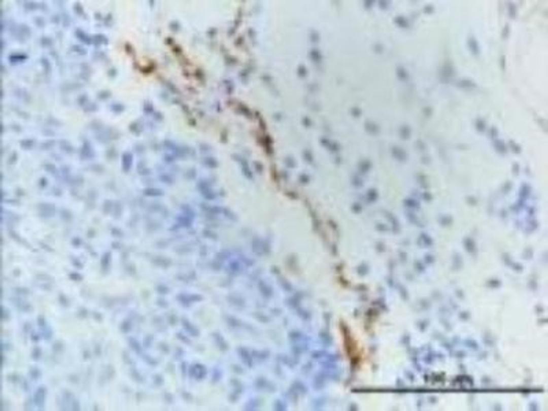 Immunohistochemistry-Paraffin: LYVE-1 Antibody [NB100-725] - Analysis using the DyLight 488 conjugate of NB100-725. Staining of LYVE1 in paraffin embedded MDA-MB-231 breast cancer orthotopic transplantation tissue. Image courtesy of product review submitted by Luana Schito.