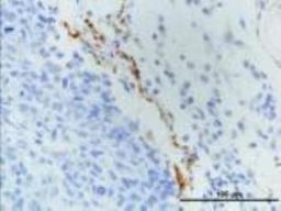 Immunohistochemistry-Paraffin: LYVE-1 Antibody [NB100-725] - Analysis using the DyLight 488 conjugate of NB100-725. Staining of LYVE1 in paraffin embedded MDA-MB-231 breast cancer orthotopic transplantation tissue. Image courtesy of product review submitted by Luana Schito.