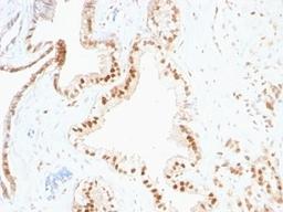 Formalin-fixed, paraffin-embedded human prostate carcinoma stained with p27 antibody (SPM348)