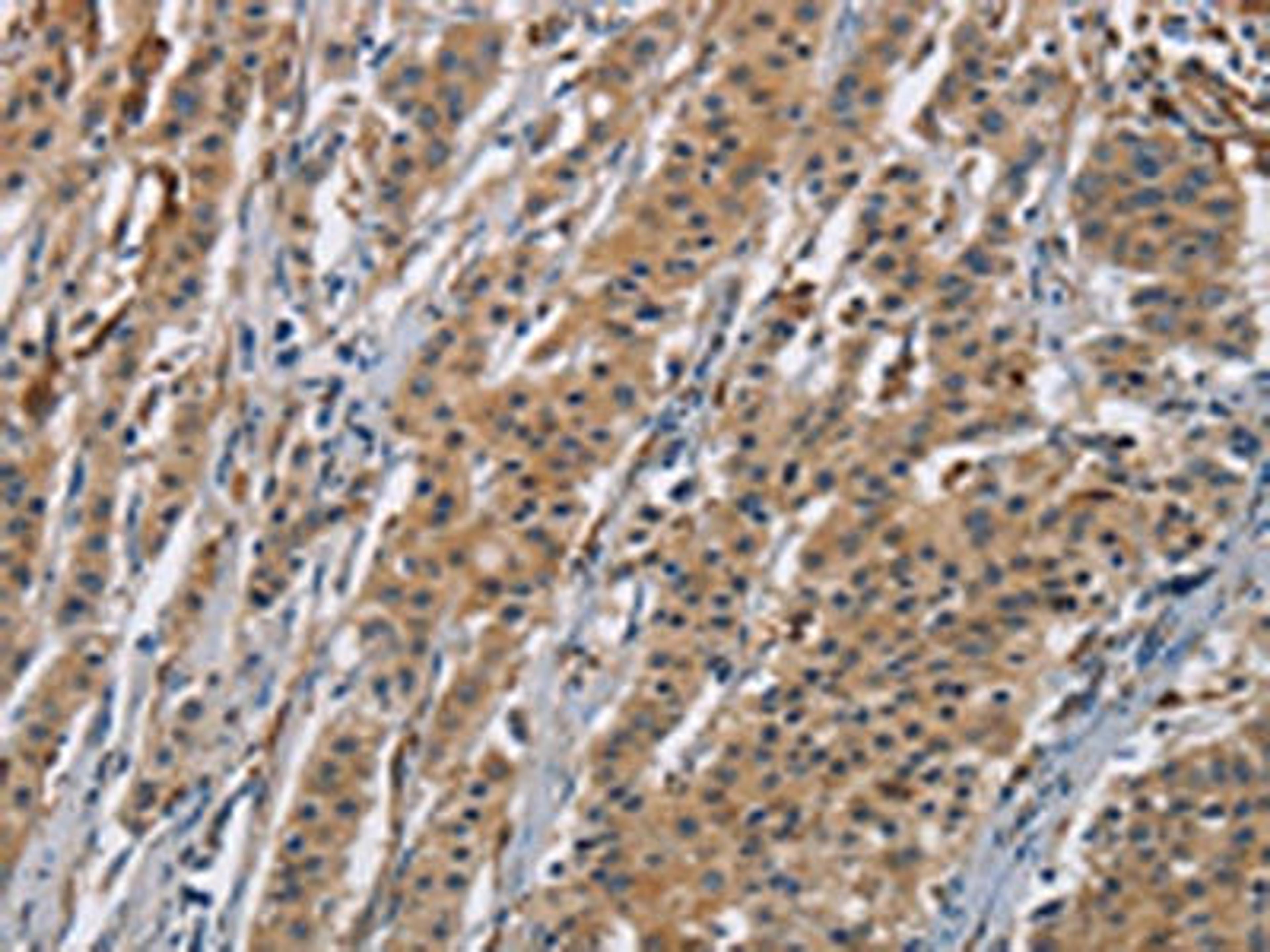 The image is immunohistochemistry of paraffin-embedded Human gastric cancer tissue using CSB-PA066696(AGER Antibody) at dilution 1/70. (Original magnification: ×200)