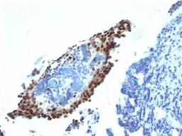 Formalin-fixed, paraffin-embedded bladder carcinoma stained with p21 antibody (HJ21).