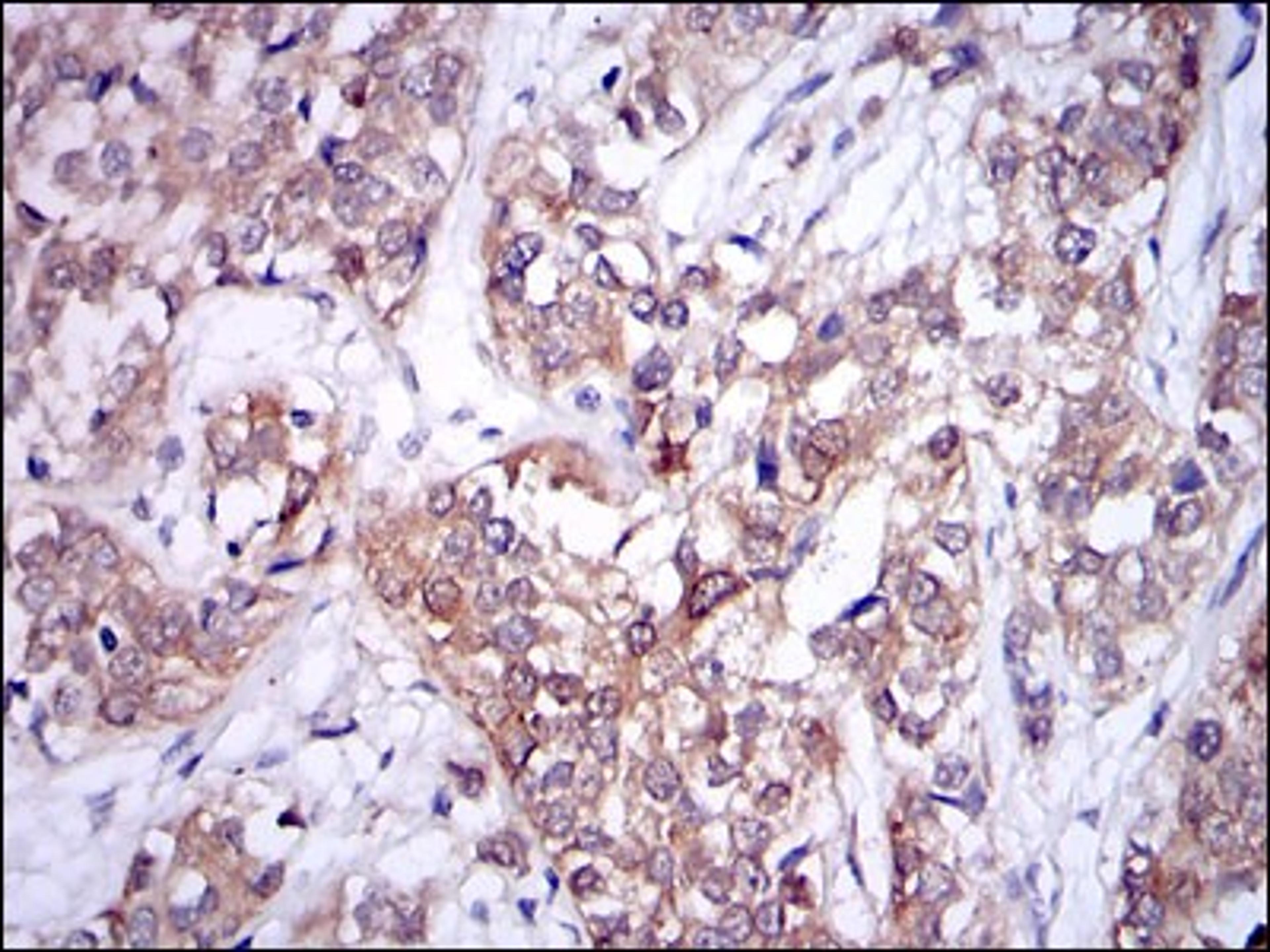 Immunohistochemistry: UBE2I/Ubc9 Antibody (1B10) [NBP2-37547] - Immunohistochemical analysis of paraffin-embedded bladder cancer tissues using UBE2I mouse mAb with DAB staining.