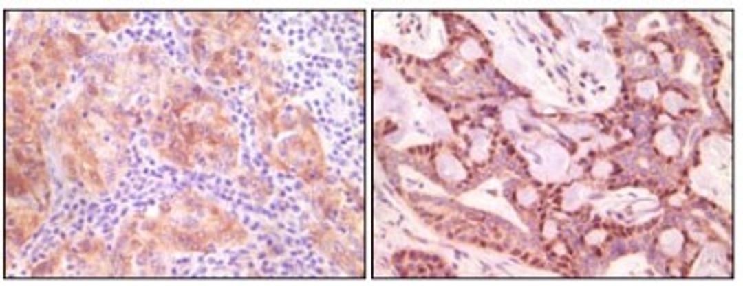 Immunohistochemistry-Paraffin: Synuclein-gamma Antibody (1H10D2) [NB110-60497] - Immunohistochemical analysis of paraffin-embedded human ovary carcinoma (left) and breast carcinoma (right), showing cytoplasmic(ovary carcinoma) localization, cytoplasmic and nuclear (breast carcinoma) localization using SNCG mouse mAb with DAB staining.