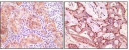 Immunohistochemistry-Paraffin: Synuclein-gamma Antibody (1H10D2) [NB110-60497] - Immunohistochemical analysis of paraffin-embedded human ovary carcinoma (left) and breast carcinoma (right), showing cytoplasmic(ovary carcinoma) localization, cytoplasmic and nuclear (breast carcinoma) localization using SNCG mouse mAb with DAB staining.