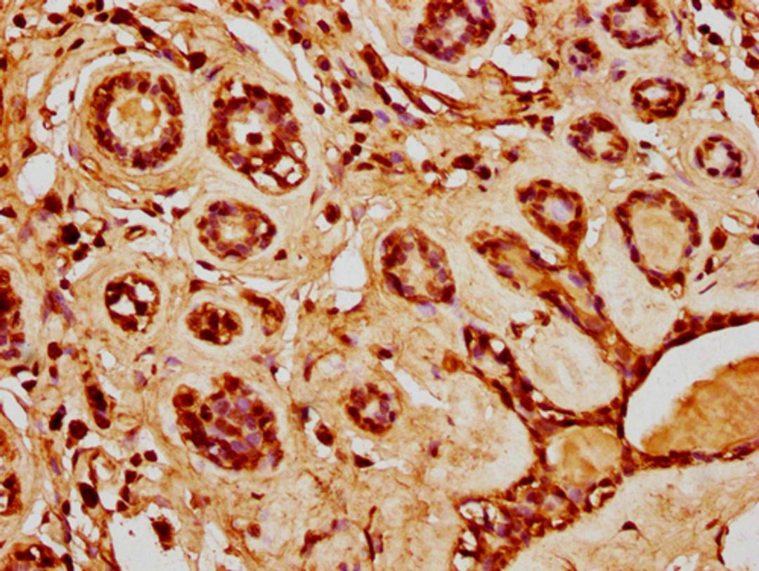 IHC image of CSB-PA010429PA20nacHU diluted at 1:20 and staining in paraffin-embedded human breast cancer performed on a Leica BondTM system. After dewaxing and hydration, antigen retrieval was mediated by high pressure in a citrate buffer (pH 6.0). Section was blocked with 10% normal goat serum 30min at RT. Then primary antibody (1% BSA) was incubated at 4°C overnight. The primary is detected by a biotinylated secondary antibody and visualized using an HRP conjugated SP system.