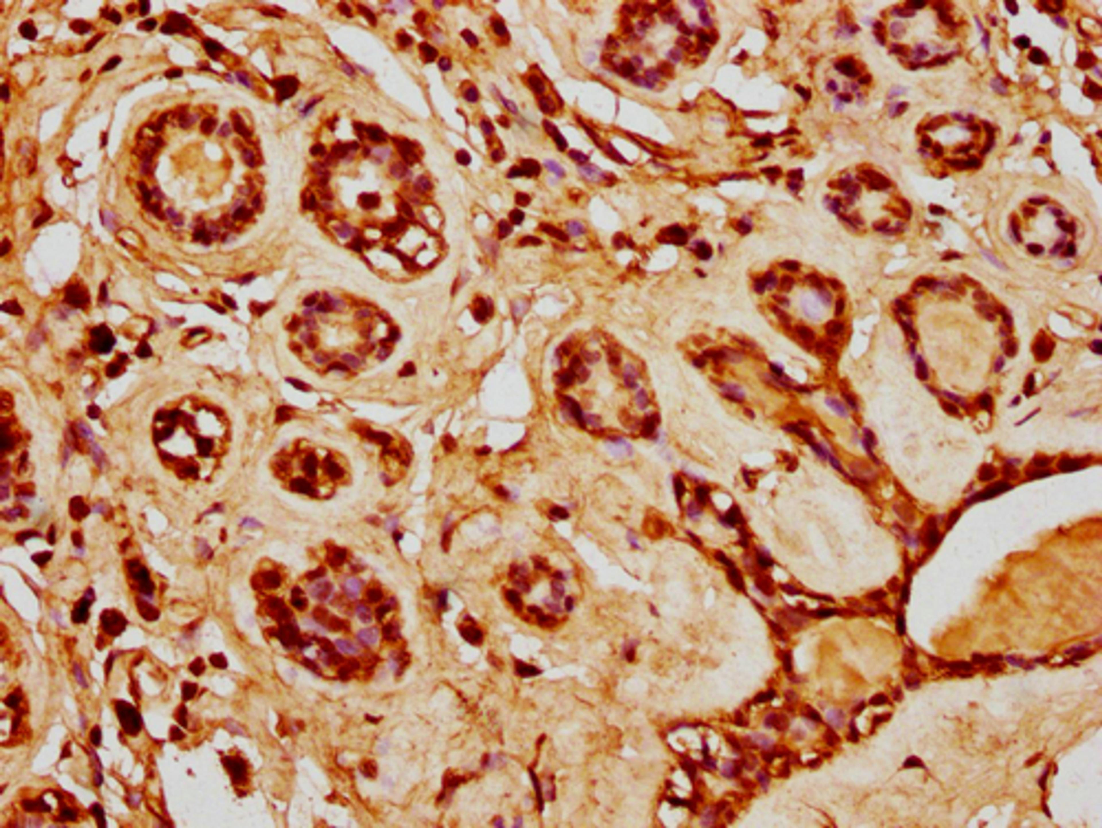 IHC image of CSB-PA010429PA20nacHU diluted at 1:20 and staining in paraffin-embedded human breast cancer performed on a Leica BondTM system. After dewaxing and hydration, antigen retrieval was mediated by high pressure in a citrate buffer (pH 6.0). Section was blocked with 10% normal goat serum 30min at RT. Then primary antibody (1% BSA) was incubated at 4°C overnight. The primary is detected by a biotinylated secondary antibody and visualized using an HRP conjugated SP system.
