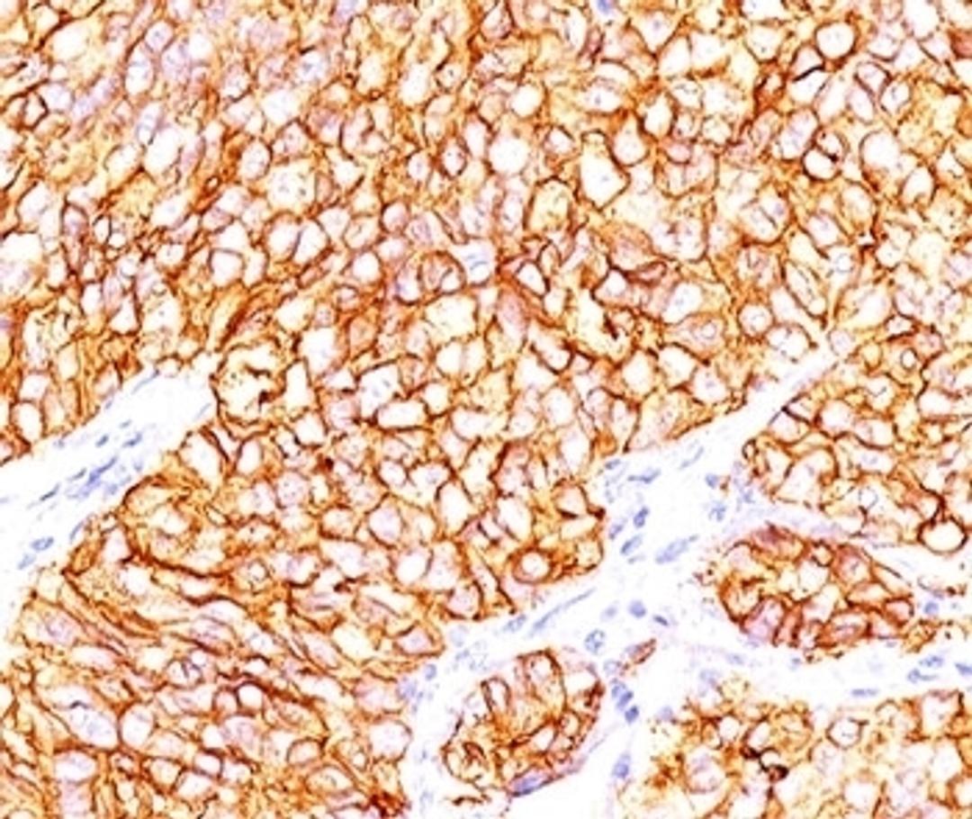 Formalin-paraffin human renal cell carcinoma stained with CAIX antibody (66.4.C2). Note cytoplasmic & cell surface staining of tumor cells.