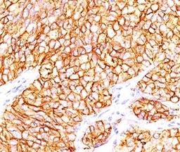 Formalin-paraffin human renal cell carcinoma stained with CAIX antibody (66.4.C2). Note cytoplasmic & cell surface staining of tumor cells.