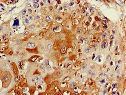 Immunohistochemistry of paraffin-embedded human cervical cancer using CSB-PA724947LA01HU at dilution of 1:100