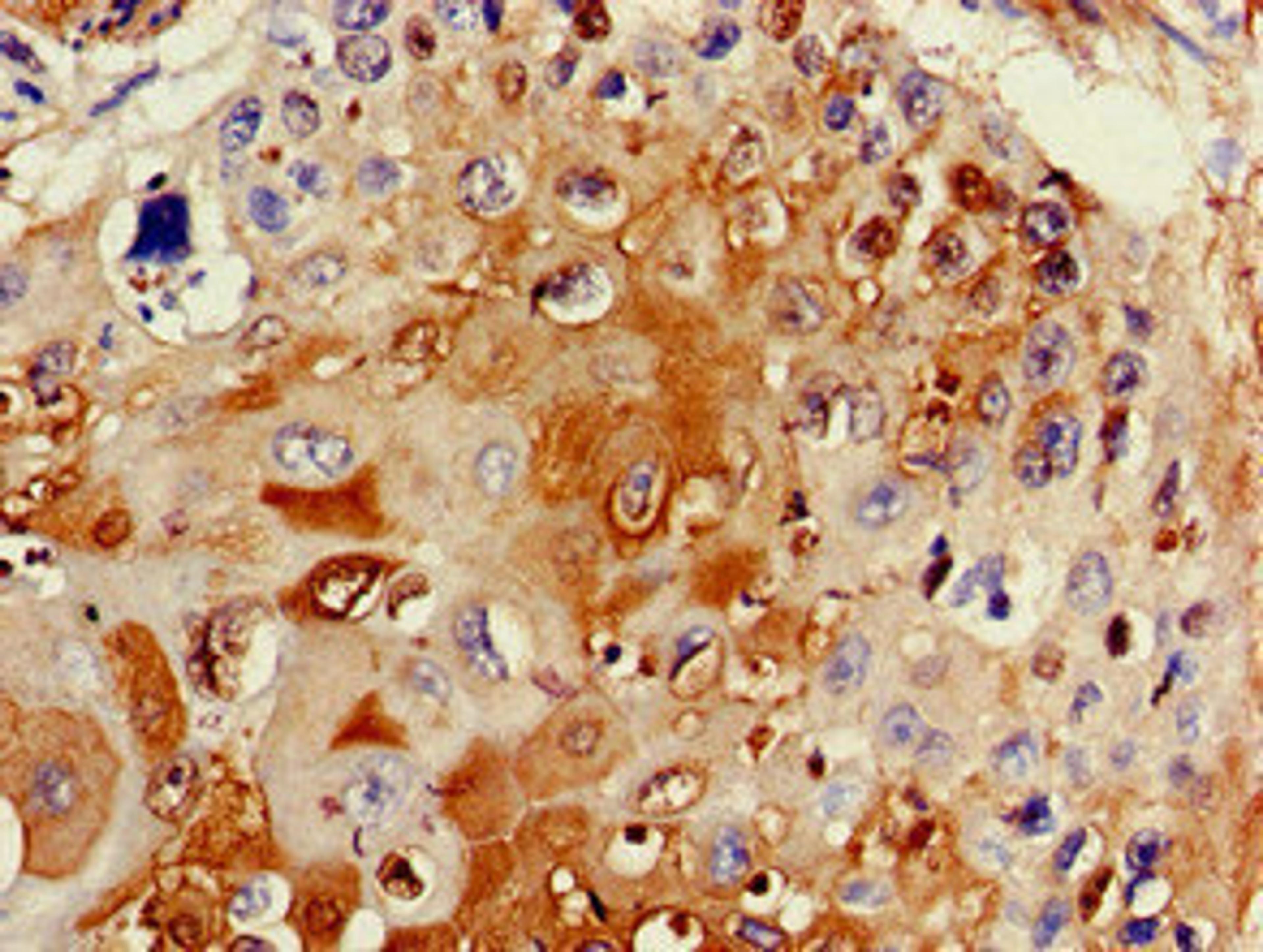Immunohistochemistry of paraffin-embedded human cervical cancer using CSB-PA724947LA01HU at dilution of 1:100