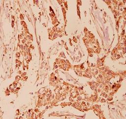 Immunohistochemistry-Paraffin: Glucagon Antibody [NB100-91782] - Human breast carcinoma tissue.