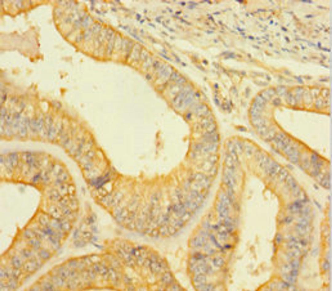 Immunohistochemistry of paraffin-embedded human endometrial cancer using CSB-PA05829A0Rb at dilution of 1:100