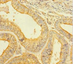 Immunohistochemistry of paraffin-embedded human endometrial cancer using CSB-PA05829A0Rb at dilution of 1:100