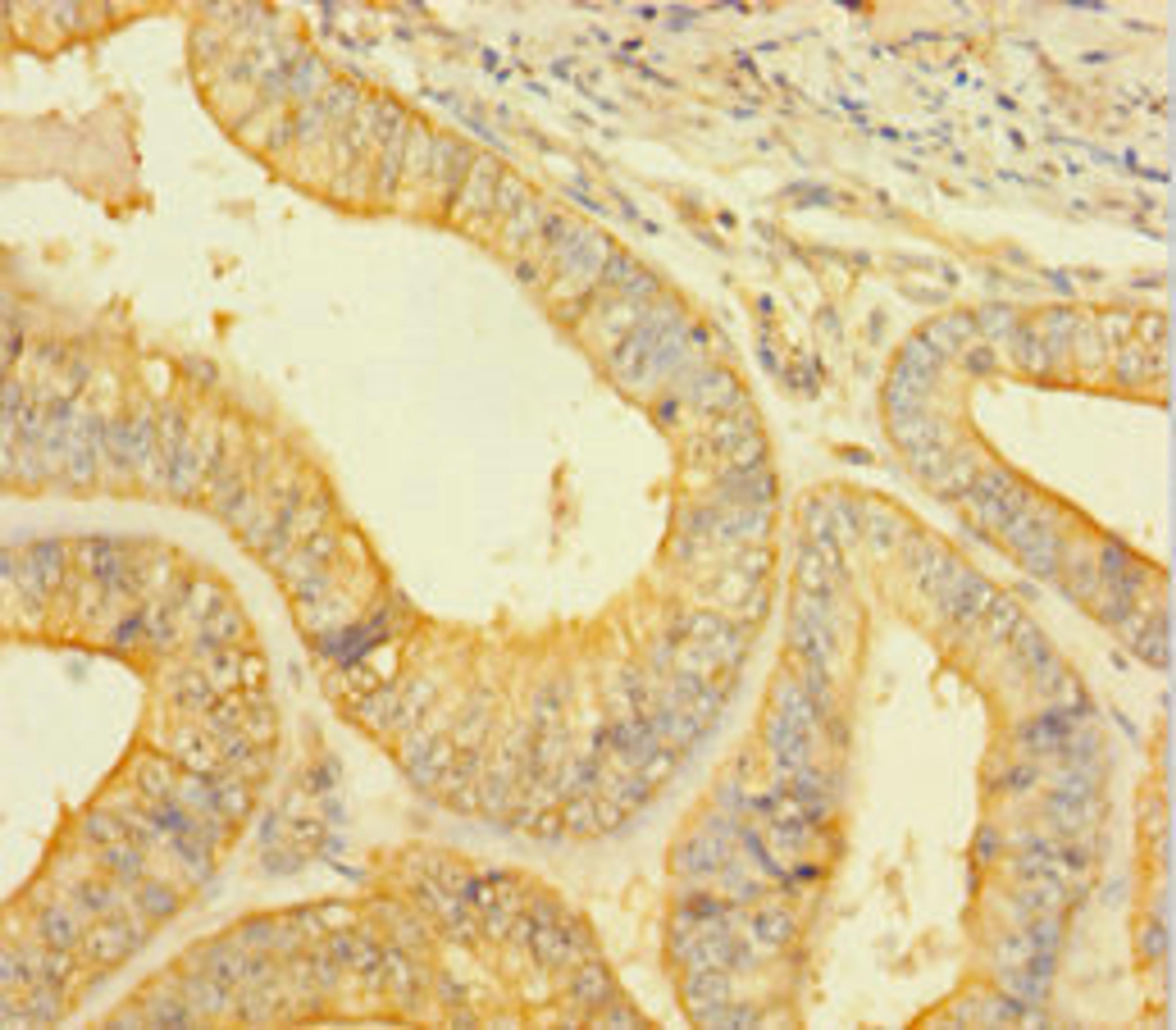Immunohistochemistry of paraffin-embedded human endometrial cancer using CSB-PA05829A0Rb at dilution of 1:100