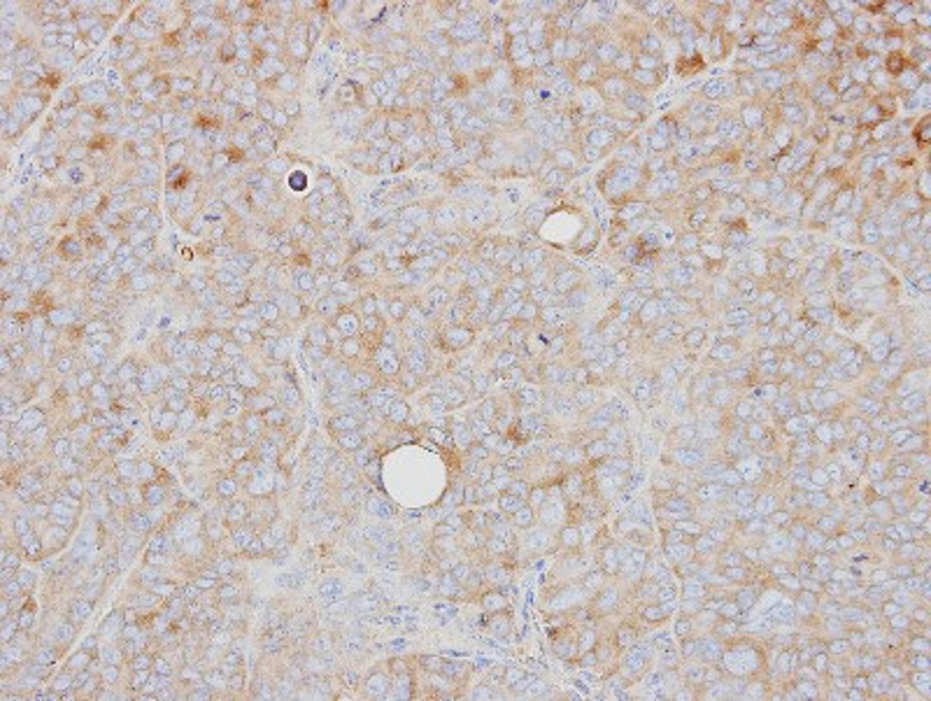 Immunohistochemistry-Paraffin: PRPS1 Antibody [NBP1-31654] - Paraffin-embedded SW480 xenograft, using antibody at 1:500 dilution.