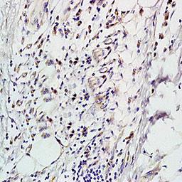 Immunohistochemical analysis of formalin-fixed and paraffin embedded human colon carcinoma tissue (dilution at:1:200) using LIF Receptor antibody