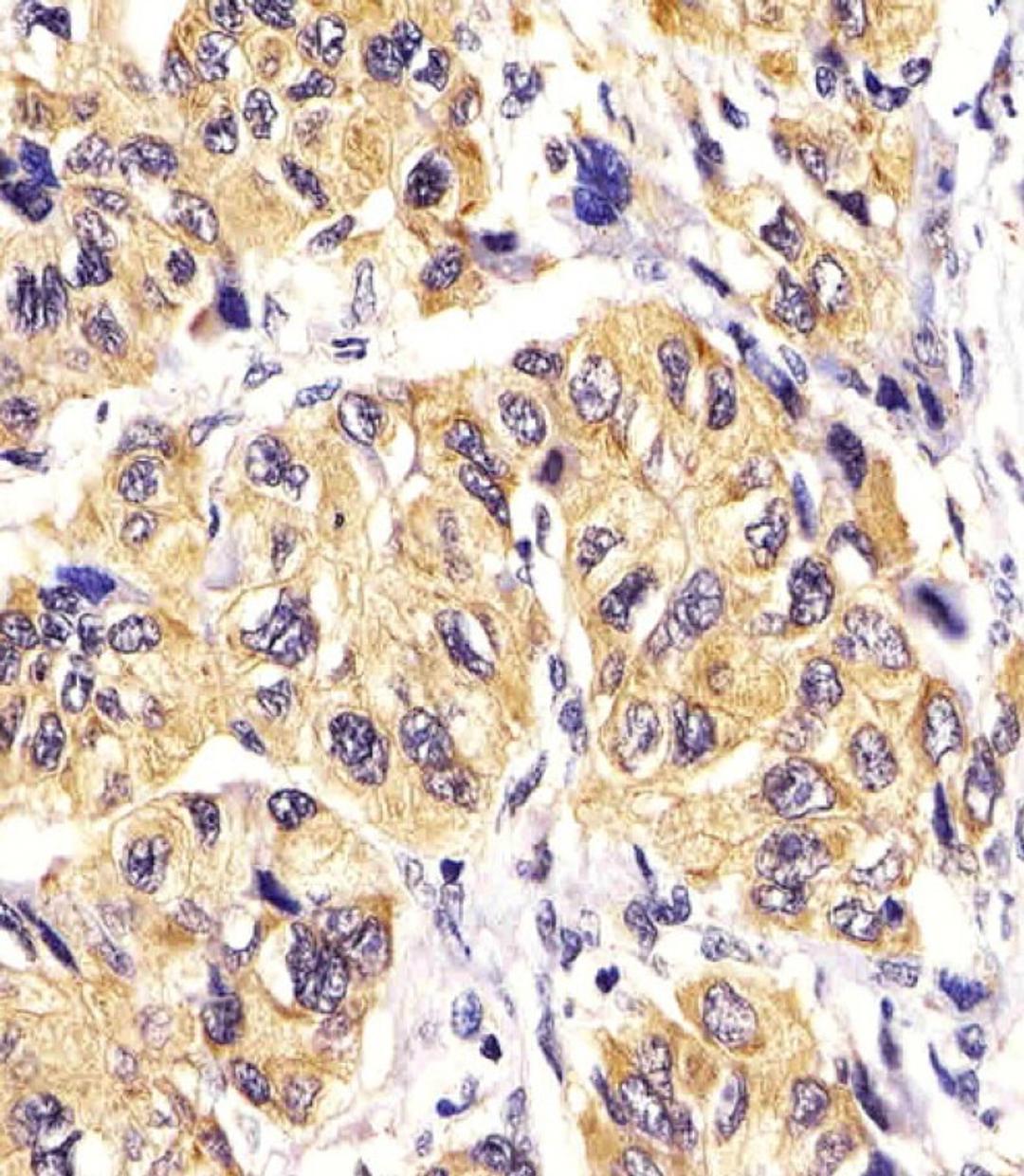 Antibody staining PDGFRA in Human hepatic carcinoma tissue sections by Immunohistochemistry (IHC-P - paraformaldehyde-fixed, paraffin-embedded sections).