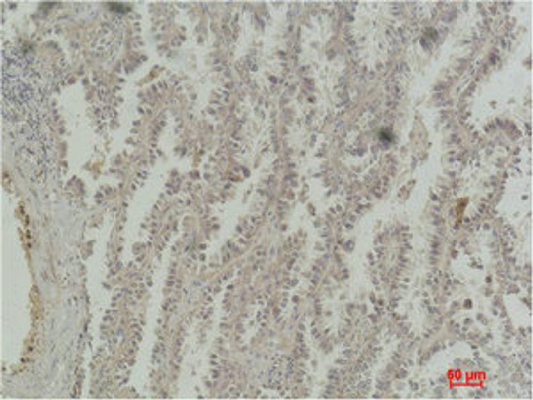 Immunohistochemical analysis of paraffin-embedded Human Lung Carcinoma using CREB-1 Monoclonal Antibody.
