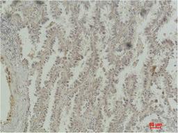 Immunohistochemical analysis of paraffin-embedded Human Lung Carcinoma using CREB-1 Monoclonal Antibody.