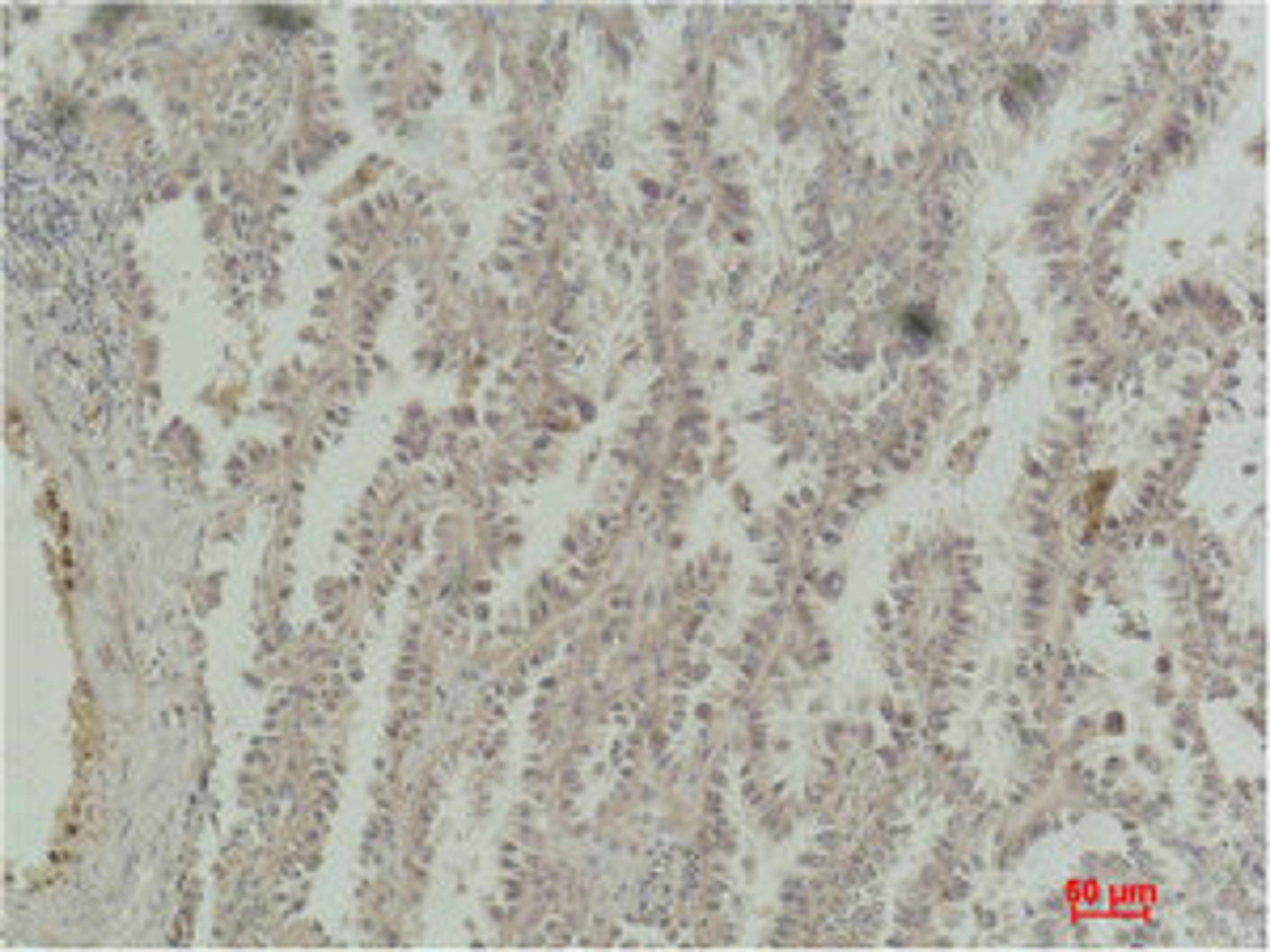 Immunohistochemical analysis of paraffin-embedded Human Lung Carcinoma using CREB-1 Monoclonal Antibody.