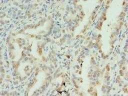 Immunohistochemistry of paraffin-embedded human lung cancer using CSB-PA859106LA01HU at dilution of 1:100