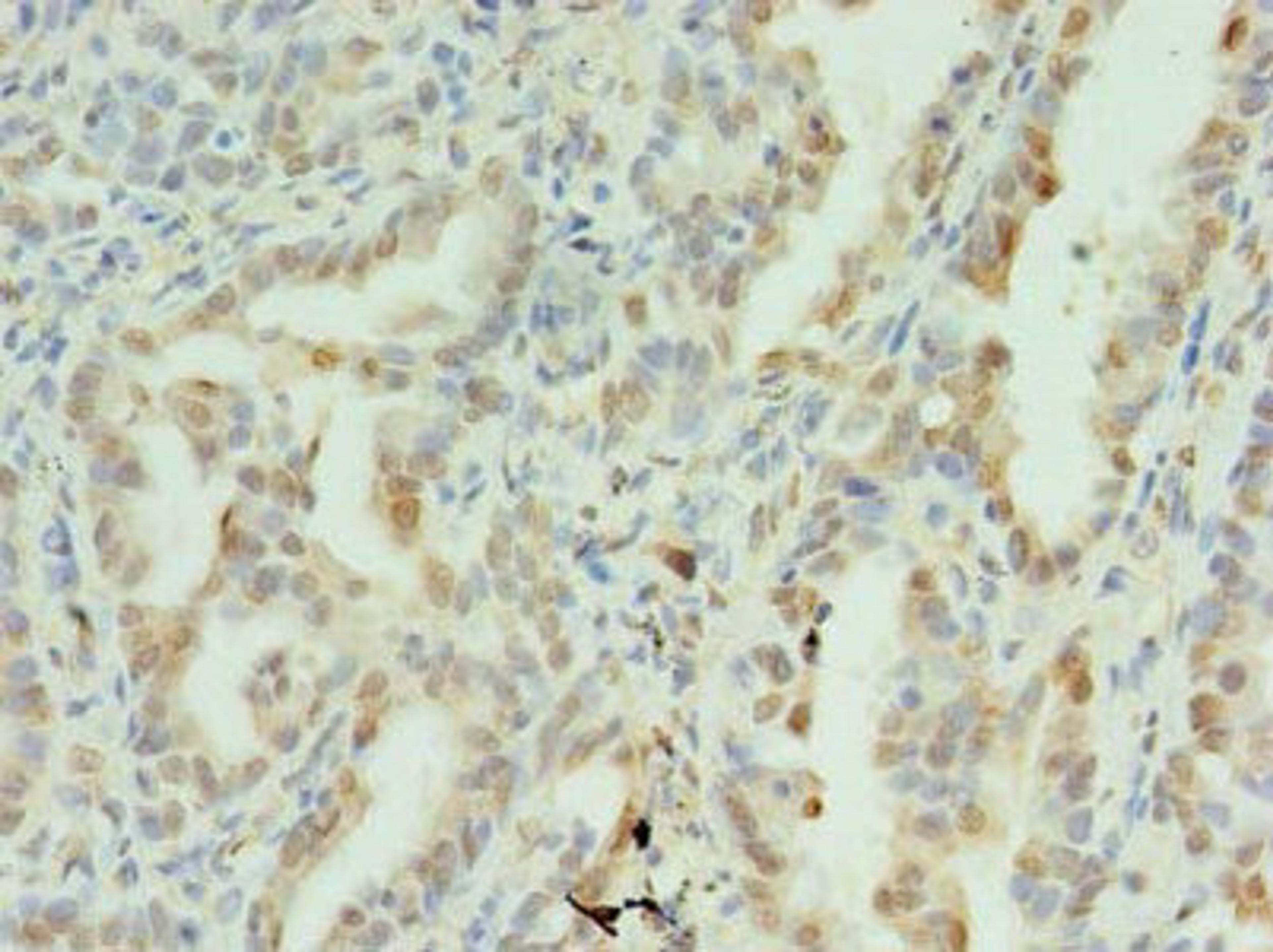 Immunohistochemistry of paraffin-embedded human lung cancer using CSB-PA859106LA01HU at dilution of 1:100
