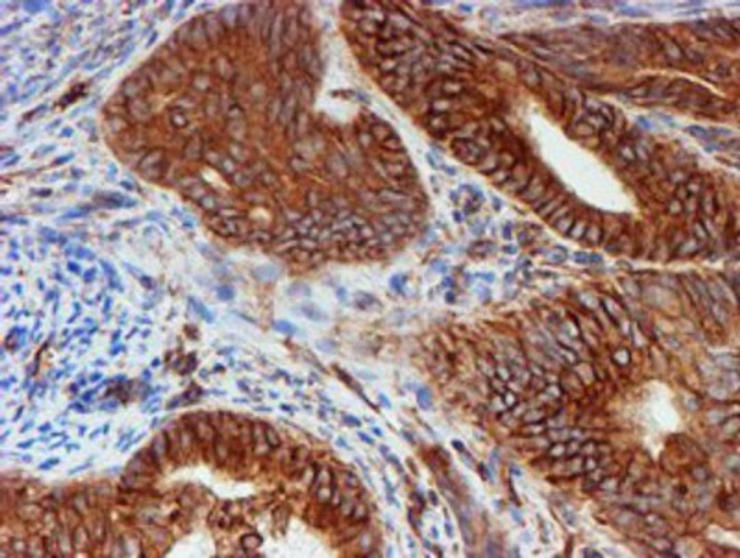 Immunohistochemistry-Paraffin: SCFD1 Antibody (5G4) [NBP2-02031] - Staining of paraffin-embedded Adenocarcinoma of Human endometrium tissue using anti-SCFD1 mouse monoclonal antibody.