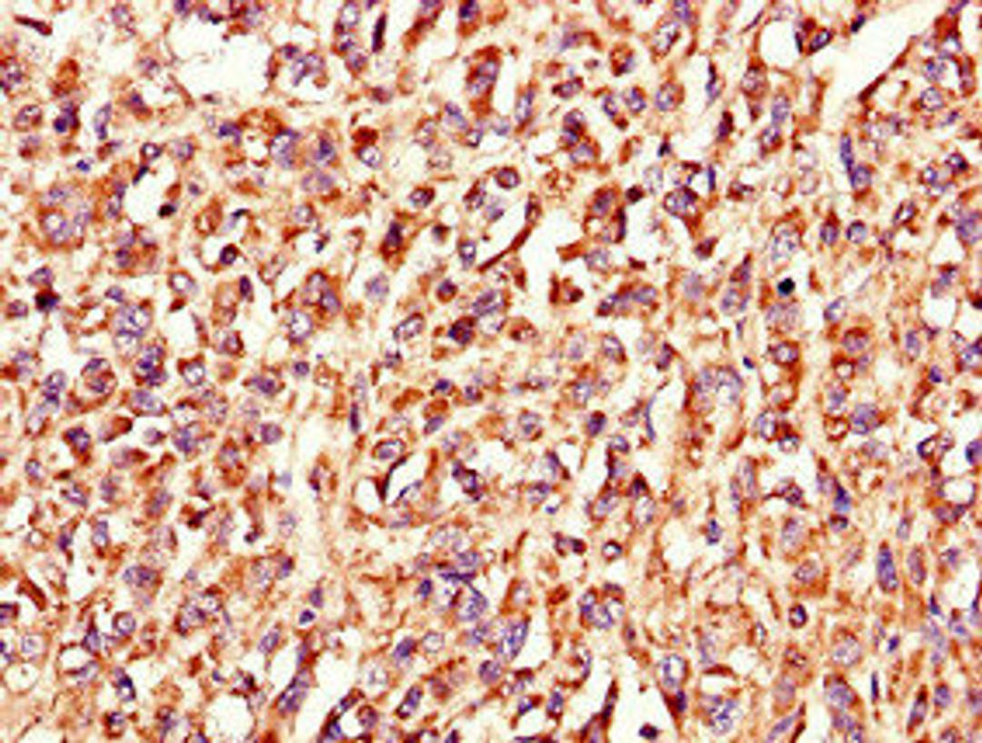 Immunohistochemistry of paraffin-embedded human melanoma using CSB-PA818730LA01HU at dilution of 1:100