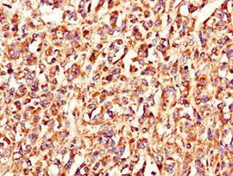 Immunohistochemistry of paraffin-embedded human melanoma using CSB-PA818730LA01HU at dilution of 1:100