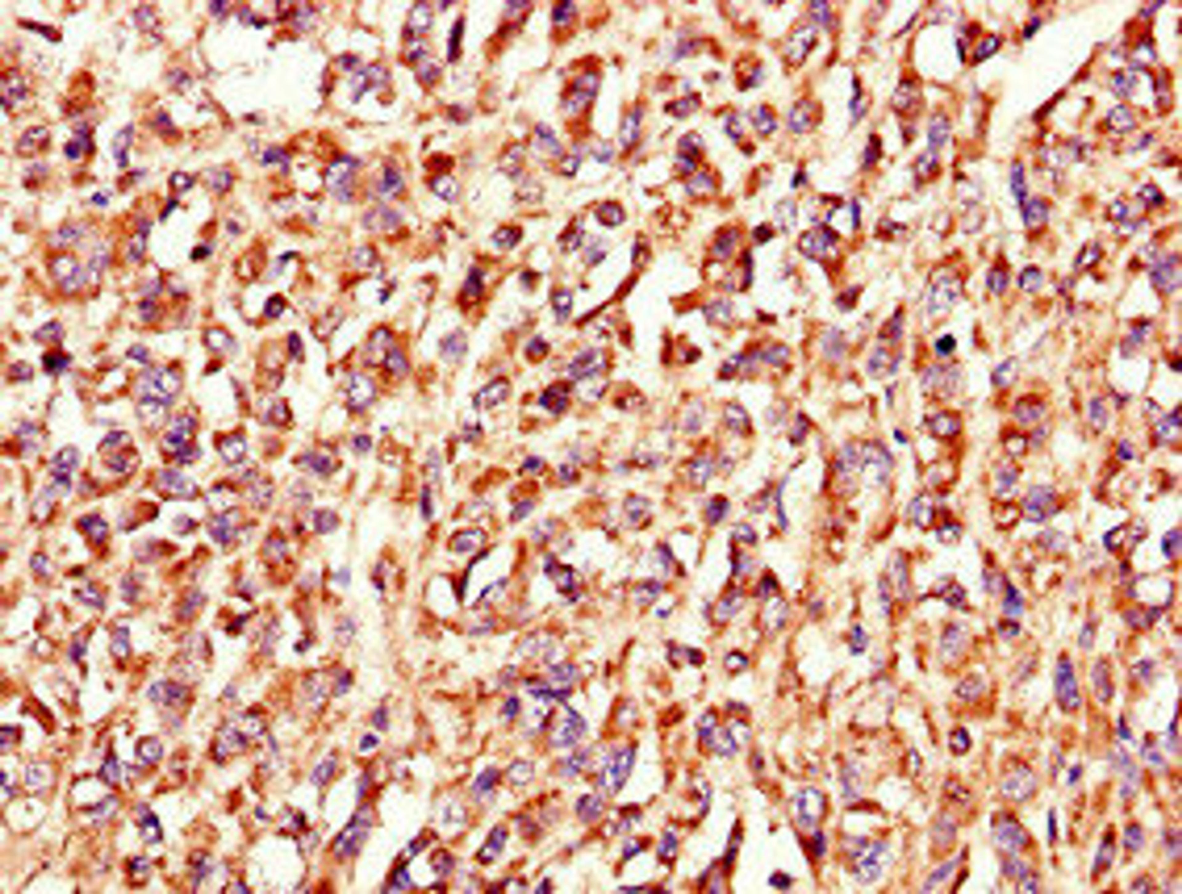 Immunohistochemistry of paraffin-embedded human melanoma using CSB-PA818730LA01HU at dilution of 1:100