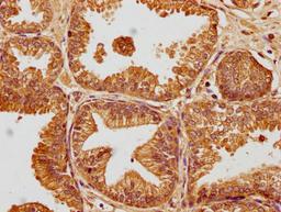 IHC image of CSB-PA009018PA01HU diluted at 1:100 and staining in paraffin-embedded human prostate cancer performed on a Leica BondTM system. After dewaxing and hydration, antigen retrieval was mediated by high pressure in a citrate buffer (pH 6.0). Section was blocked with 10% normal goat serum 30min at RT. Then primary antibody (1% BSA) was incubated at 4°C overnight. The primary is detected by a biotinylated secondary antibody and visualized using an HRP conjugated SP system.