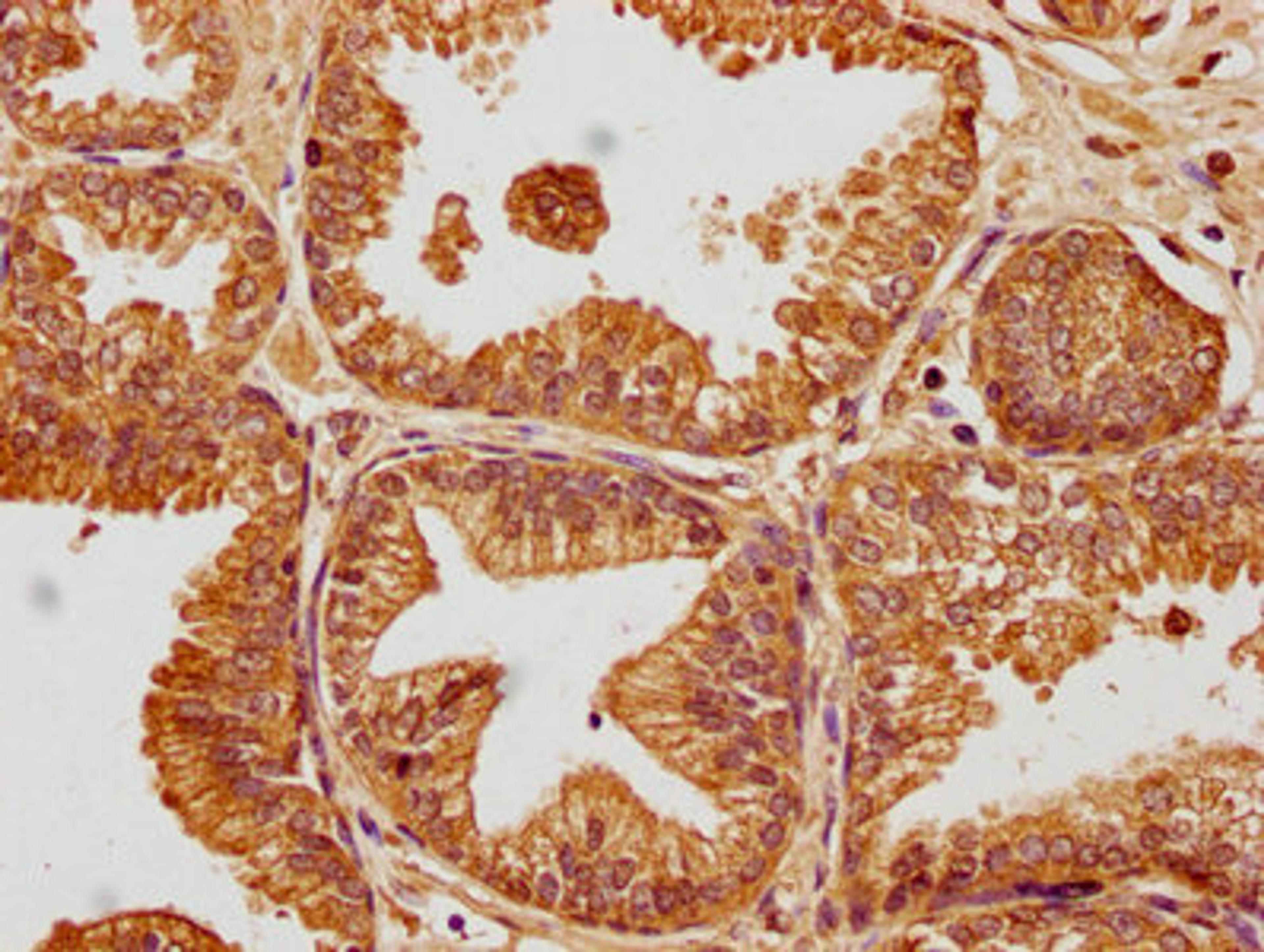 IHC image of CSB-PA009018PA01HU diluted at 1:100 and staining in paraffin-embedded human prostate cancer performed on a Leica BondTM system. After dewaxing and hydration, antigen retrieval was mediated by high pressure in a citrate buffer (pH 6.0). Section was blocked with 10% normal goat serum 30min at RT. Then primary antibody (1% BSA) was incubated at 4°C overnight. The primary is detected by a biotinylated secondary antibody and visualized using an HRP conjugated SP system.