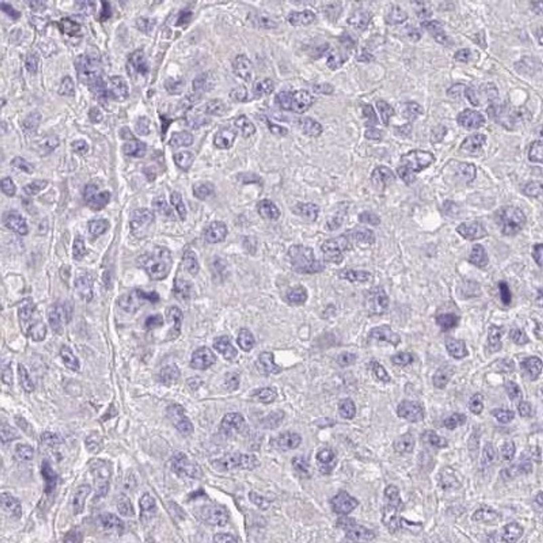 Immunohistochemistry: C6orf201 Antibody [NBP2-32586] - liver cancer