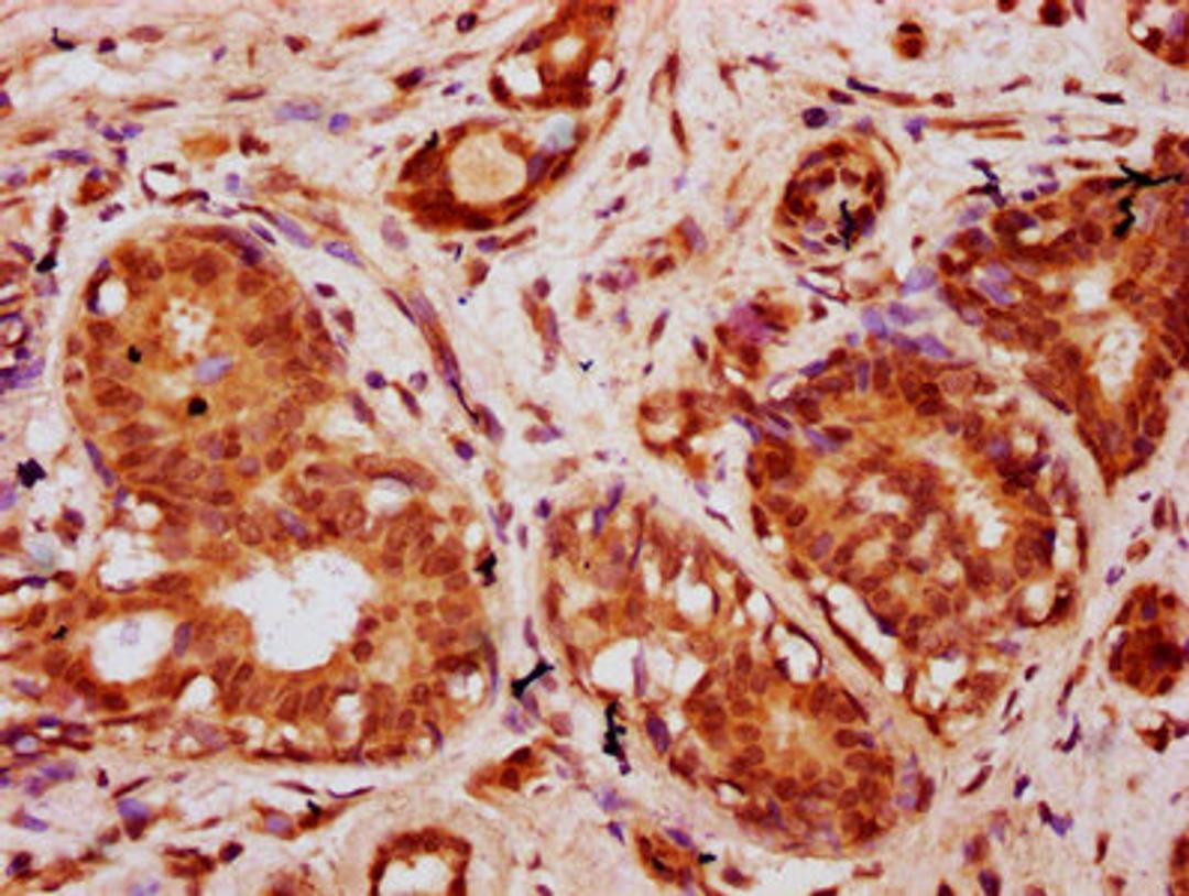 IHC image of CSB-PA010403OA20nbhbHU diluted at 1:10 and staining in paraffin-embedded human breast cancer performed on a Leica BondTM system. After dewaxing and hydration, antigen retrieval was mediated by high pressure in a citrate buffer (pH 6.0). Section was blocked with 10% normal goat serum 30min at RT. Then primary antibody (1% BSA) was incubated at 4&deg;C overnight. The primary is detected by a biotinylated secondary antibody and visualized using an HRP conjugated SP system.