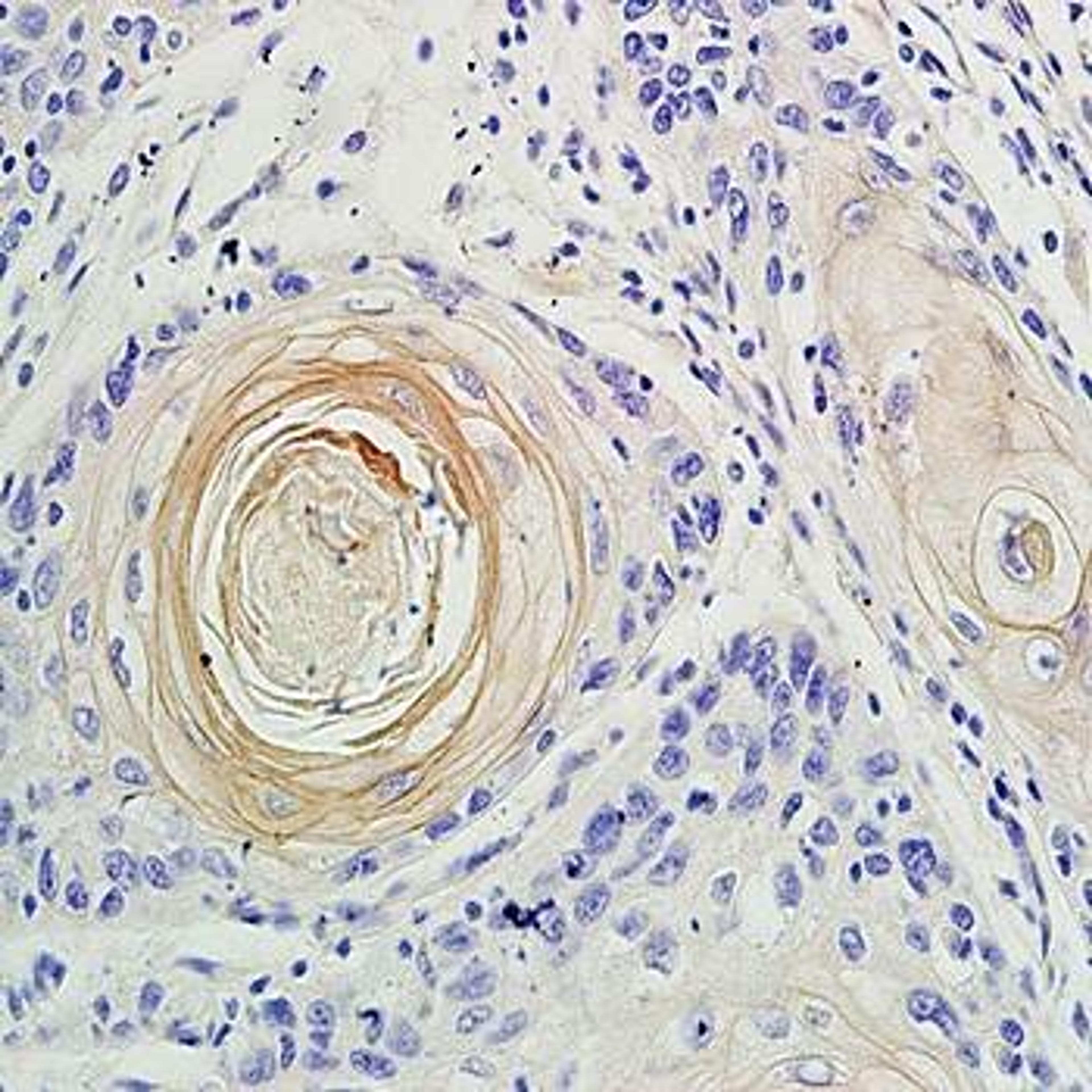 Immunohistochemical analysis of formalin-fixed and paraffin embedded human oral squamous cell carcinoma tissue (Dilution at:1:200) using IL17 antibody