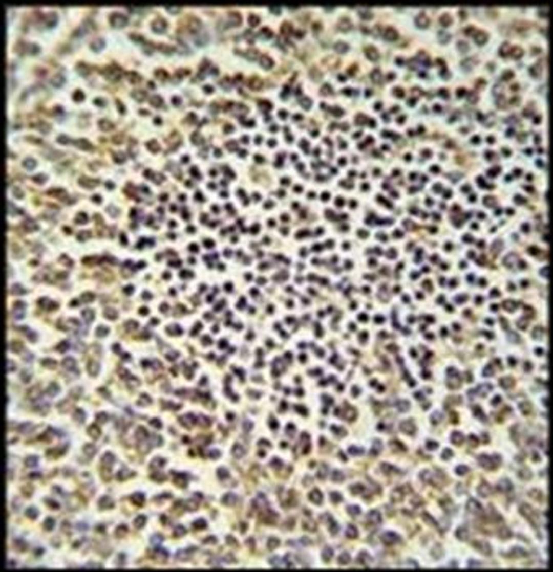 Immunohistochemical staining of paraffin embedded human spleen carcinoma tissue using CARD9 antibody (primary antibody dilution at: 1:50-100)