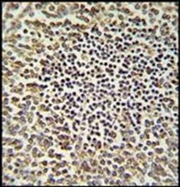 Immunohistochemical staining of paraffin embedded human spleen carcinoma tissue using CARD9 antibody (primary antibody dilution at: 1:50-100)