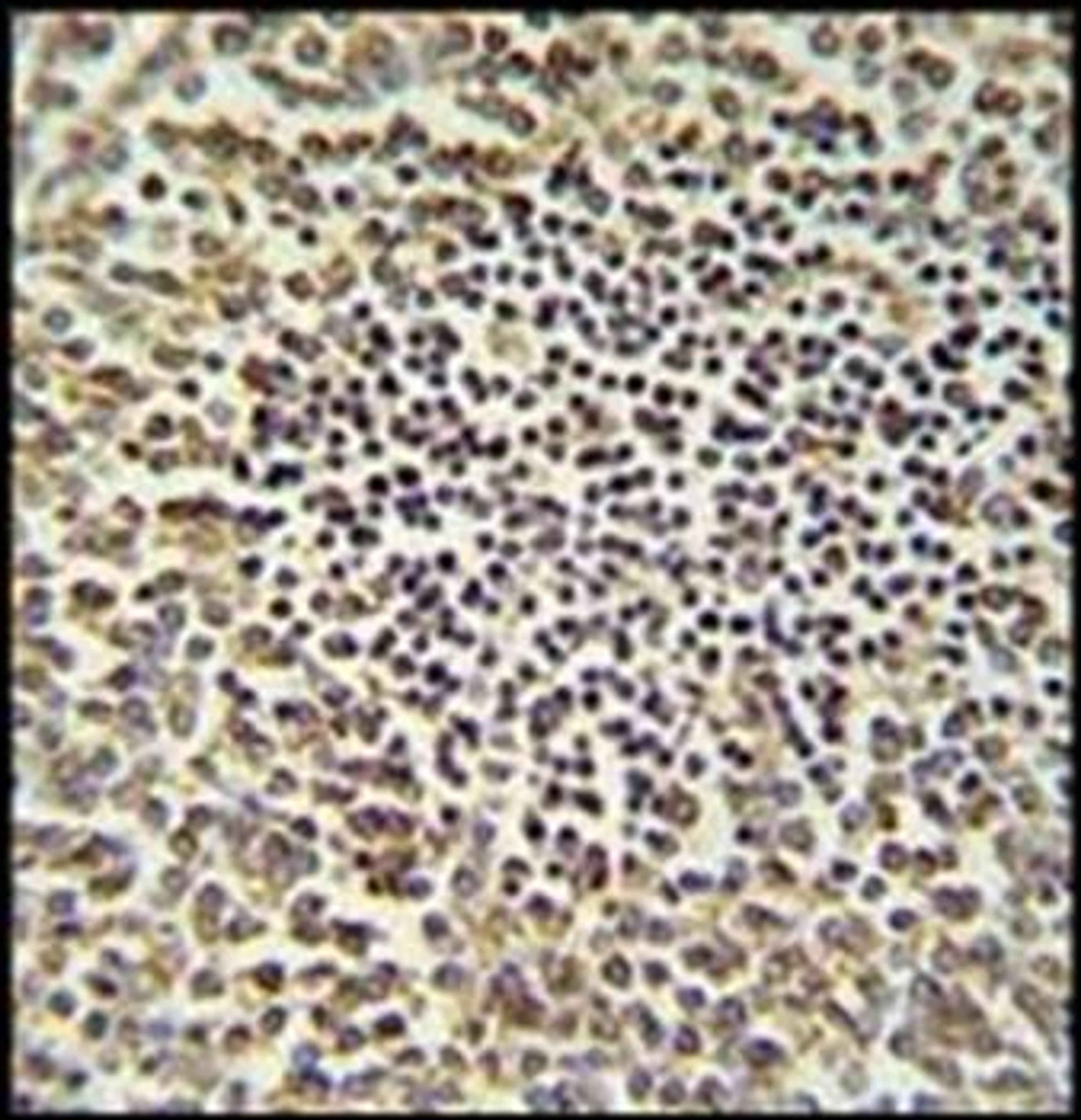 Immunohistochemical staining of paraffin embedded human spleen carcinoma tissue using CARD9 antibody (primary antibody dilution at: 1:50-100)