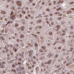 Immunohistochemistry: WDR58 Antibody [NBP2-31390] - liver cancer