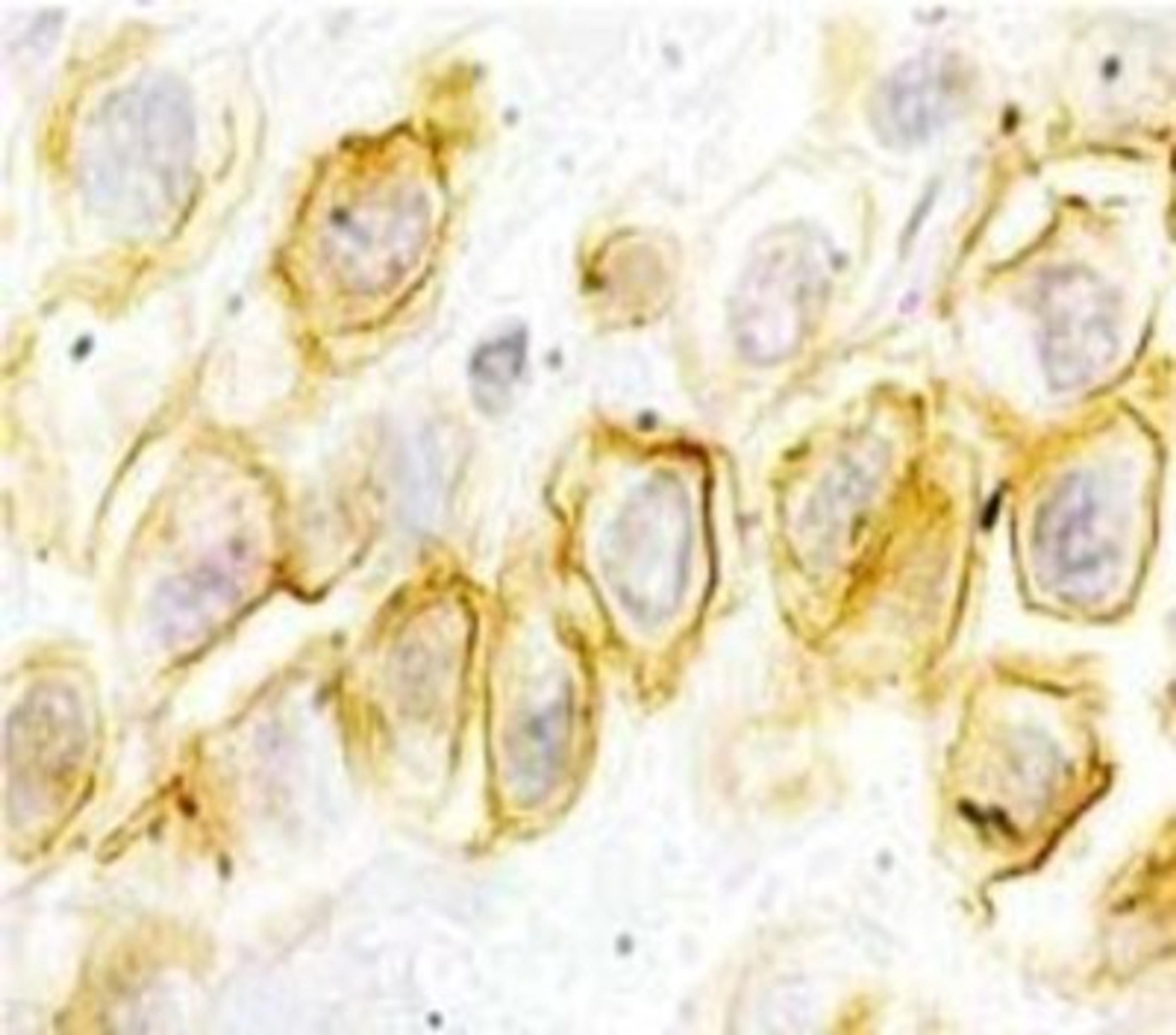 Immunohistochemistry-Paraffin: Gastrin-releasing Peptide R/GRPR Antibody [NB100-74434] - Staining of human mammary carcinoma tissue sections.