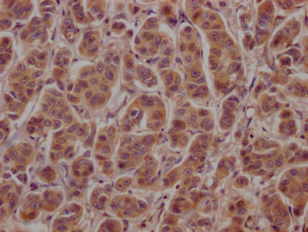 IHC image of CSB-PA002272LA01HU diluted at 1:100 and staining in paraffin-embedded human breast cancer performed on a Leica BondTM system. After dewaxing and hydration, antigen retrieval was mediated by high pressure in a citrate buffer (pH 6.0). Section was blocked with 10% normal goat serum 30min at RT. Then primary antibody (1% BSA) was incubated at 4°C overnight. The primary is detected by a Goat anti-rabbit polymer IgG labeled by HRP and visualized using 0.05% DAB.