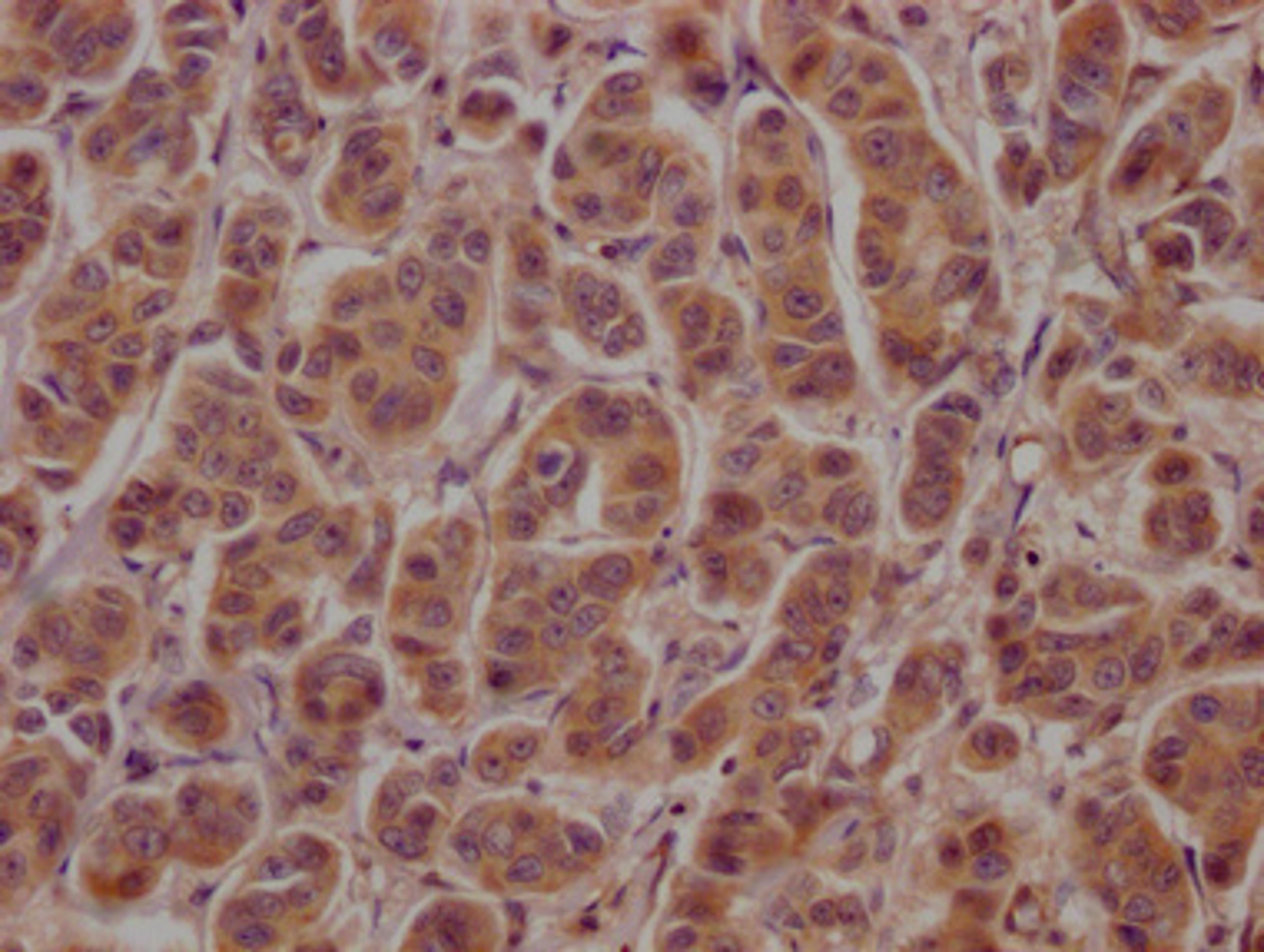 IHC image of CSB-PA002272LA01HU diluted at 1:100 and staining in paraffin-embedded human breast cancer performed on a Leica BondTM system. After dewaxing and hydration, antigen retrieval was mediated by high pressure in a citrate buffer (pH 6.0). Section was blocked with 10% normal goat serum 30min at RT. Then primary antibody (1% BSA) was incubated at 4°C overnight. The primary is detected by a Goat anti-rabbit polymer IgG labeled by HRP and visualized using 0.05% DAB.